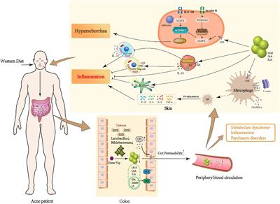 Potential roles of gut microbial tryptophan metabolites in the complex pathogenesis of acne vulgaris